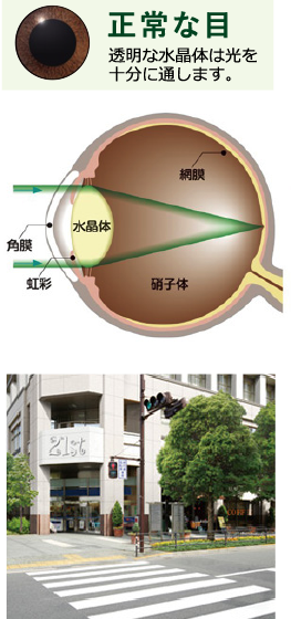 正常な目