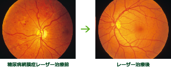 糖尿病網膜症レーザー治療前→レーザー治療後