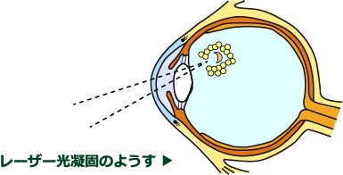 レーザー光凝固のようす