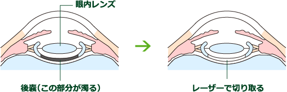 ヤグレーザー治療とは2